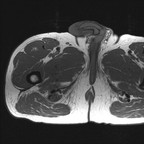 Désinsertion du tendon commun biceps fémoral - semitendineux au niveau de leur insertion ischiatique IRM axial T1 Désinsertion du tendon commun biceps fémoral - semitendineux au niveau de leur insertion ischiatique IRM axial T1