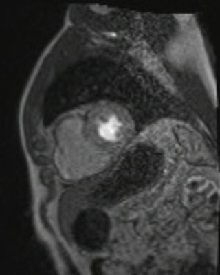 Dysplasie arythmogène du ventriule droit (DAVD) : critère majeur en IRM PERFUSION RespLib _dynamic_rest_MOCO