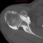 Tendinopathie fissulaire long biceps TDM Membre supérieur Axial Tendinopathie fissulaire long biceps TDM Membre supérieur Axial