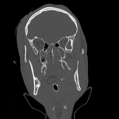 traumatisme cranien, oedème pulmonaire, lacération du rein crane coro os
