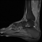 Rupture du tendon court fibulaire IRM DP fat sat Rupture du tendon court fibulaire IRM DP fat sat