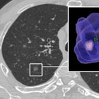 Solitary Pulmonary Nodule Solitary-Pulmonary-Nodule-Guidelines-from-the-Fleischner-Society Solitary Pulmonary Nodule Solitary-Pulmonary-Nodule-Guidelines-from-the-Fleischner-Society