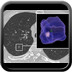 Solitary Pulmonary Nodule Solitary-Pulmonary-Nodule-Guidelines-from-the-Fleischner-Society