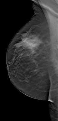 Asymétrie mammaire avec petit nodule dont l’aspect est en faveur d’un fibroadénome au sein d'un tissu glandulaire plus dense à droite. RMLO Tomosynthèse