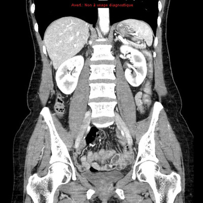 Veine rénale gauche circumaortique  TDM Abdomen Coronal Temps veineux