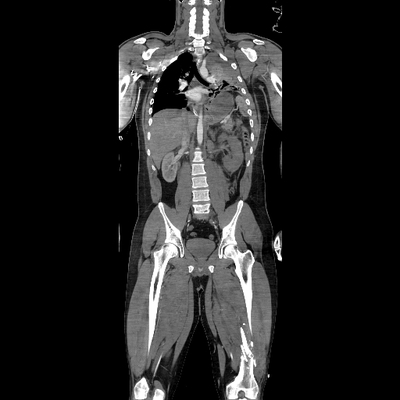 hernie diaphragmatique, traumatisme thoracique, traumatisme abdominal, burst fracture, fracture du pied TAP-MI artériel coro