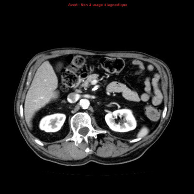 Hydatidose thoracique, hépatique et splénique avec nodules pulmonaires excavés  TDM Thorax Axial Fenêtre Tissus mous