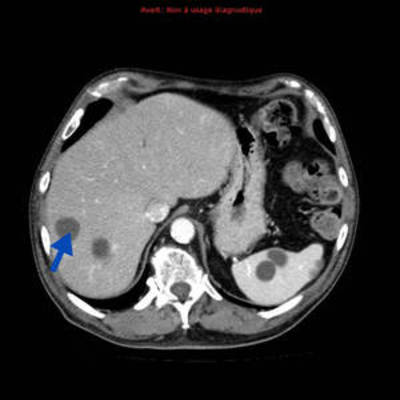 Hydatidose thoracique, hépatique et splénique avec nodules pulmonaires excavés  TDM Thorax Axial Fenêtre Tissus mous