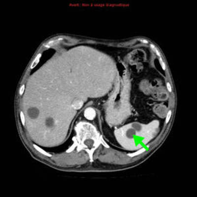 Hydatidose thoracique, hépatique et splénique avec nodules pulmonaires excavés  TDM Thorax Axial Fenêtre Tissus mous