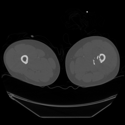 Traumatic diaphragmatic rupture, Thoracic and abdominal injuries, burst vertebral fracture, foot injuries Lower limbs, Axial plane, Bone window