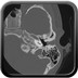 Aplasie mineure de l'oreille gauche  TDM rocher gauche : axial