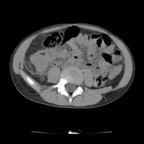 Infarctus du grand épiploon TDM abdominale Infarctus du grand épiploon TDM abdominale