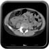Infarctus du grand épiploon TDM abdominale