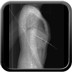 Traumatisme pénétrant abdominal par couteau  Radiographie Abdomen Profil