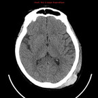 Hématome sous-dural par lésion de contre-coup TDM Crâne Axial Sans injection Hématome sous-dural par lésion de contre-coup TDM Crâne Axial Sans injection