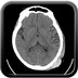 Hématome sous-dural par lésion de contre-coup  TDM Crâne Axial Sans injection