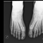 Séquelle d'une maladie de Freiberg Avant pieds Face Séquelle d'une maladie de Freiberg Avant pieds Face