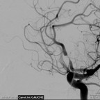 Dissection idiopathique artère cérébrale antérieure Interventionnel Crâne Dissection idiopathique artère cérébrale antérieure Interventionnel Crâne