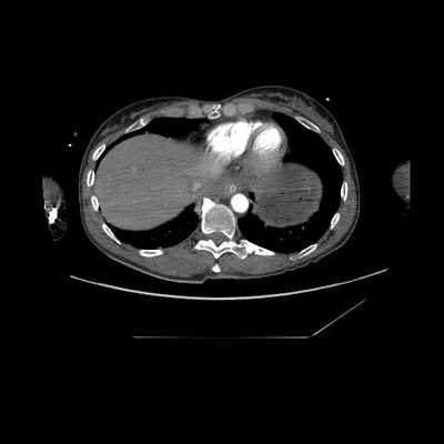 Craniocerebral trauma, Carotid artery injury with dissection, traumatic perforation of GI tract, pulmonary artery injury, Chance fracture Head CT, Chest, Abdomen and Pelvis, Arterial phase, Axial plane