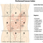 Metastastasis of the peritoneal cavity peritoneal-cancer-index Metastastasis of the peritoneal cavity peritoneal-cancer-index
