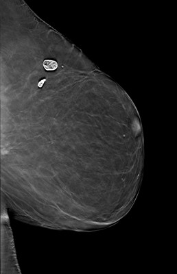 Récidive tardive de cancer du sein gauche LML Tomosynthèse