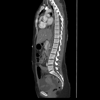 Abdominal vessels trauma, Intraperitoneal bladder rupture, Spleen infarction, Pelvic fracture Chest, Abdomen and Pelvis, Arterial phase, Sagittal plane