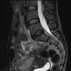 Lésion d'aspect tumoral de 4 cm de plus grand axe du col utérin, responsable d'un envahissement paramétrial bilatéral. Pas d'autre signe d'envahissement loco-régional. Sagittal T2 Lésion d'aspect tumoral de 4 cm de plus grand axe du col utérin, responsable d'un envahissement paramétrial bilatéral. Pas d'autre signe d'envahissement loco-régional. Sagittal T2