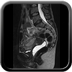 Lésion d'aspect tumoral de 4 cm de plus grand axe du col utérin, responsable d'un envahissement paramétrial bilatéral. Pas d'autre signe d'envahissement loco-régional.  Sagittal T2