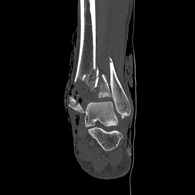fracture du condyle occipital, traumatisme thoracique, fracture et contusion hépatique, hématome de la surrénale cheville droite coro os