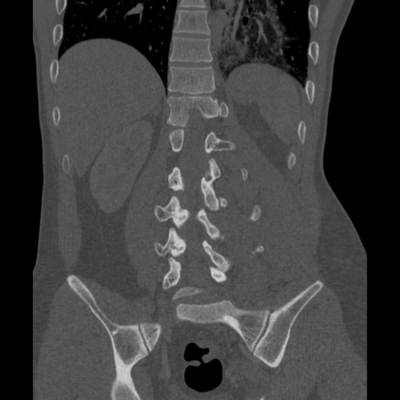 Thoracic Injuries, Spinal Injuries L5, Traumatic disc herniation Lumbar spine, Coronal plane, Bone window
