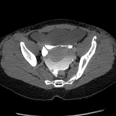 Abdominal vessels trauma, Intraperitoneal bladder rupture, Spleen infarction, Pelvic fracture Pelvic CT, Delayed phase, 15 min