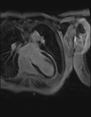 Syndrome de Tako-Tsubo - Myocardite adrénergique Rehaussement tardif - Inversion récupération - 4 cavités