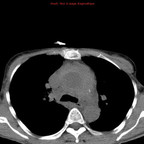 Rupture de l'aorte ascendante avec tamponnade sur hémopéricarde TDM Thorax Axial Sans injection Rupture de l'aorte ascendante avec tamponnade sur hémopéricarde TDM Thorax Axial Sans injection