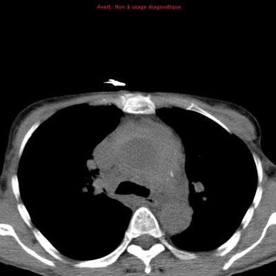 Rupture de l'aorte ascendante avec tamponnade sur hémopéricarde  TDM Thorax Axial Sans injection