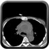 Rupture de l'aorte ascendante avec tamponnade sur hémopéricarde  TDM Thorax Axial Sans injection