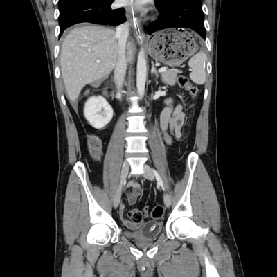 fracture du condyle occipital, traumatisme thoracique, fracture et contusion hépatique, hématome de la surrénale abdomen portal coro