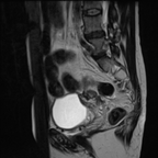 Cancer du col utérin mesurant 3,5 cm de grand axe de stade IV (envahissement vésical et adénomégalies lombo-aortique et iliaque externe droite). Lésion d'endométriose sous-péritonéale. Adénomyose diffuse. Sagittal T2 Cancer du col utérin mesurant 3,5 cm de grand axe de stade IV (envahissement vésical et adénomégalies lombo-aortique et iliaque externe droite). Lésion d'endométriose sous-péritonéale. Adénomyose diffuse. Sagittal T2