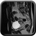Cancer du col utérin mesurant 3,5 cm de grand axe de stade IV (envahissement vésical et adénomégalies lombo-aortique et iliaque externe droite). Lésion d'endométriose sous-péritonéale. Adénomyose diffuse.  Sagittal T2