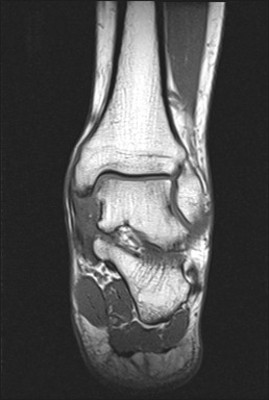Séquelles post traumatiques du ligament collatéral latéral IRM coronal T1