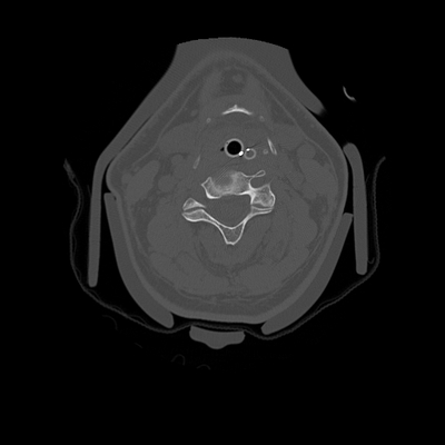 fracture du condyle occipital, traumatisme thoracique, fracture et contusion hépatique, hématome de la surrénale rachis cervical axial os