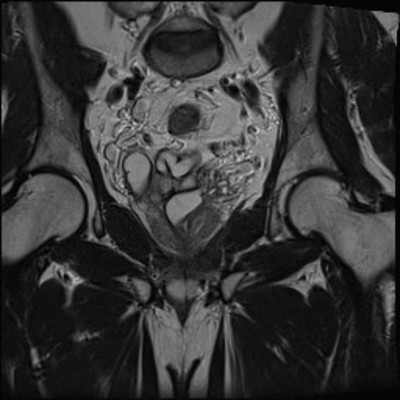 Kyste de la vésicule séminale et agénésie rénale homolatérale IRM Pelvis Coronal T2