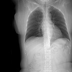 Tératome mature médiastinal Radiographie Thorax Face Tératome mature médiastinal Radiographie Thorax Face
