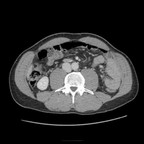 Hématome splénique sous-caspulaire post-traumatique Axial Hématome splénique sous-caspulaire post-traumatique Axial