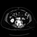 Abcès hépatiques du foie droit post diverticulite. TDM Abdomen Axial Temps veineux Abcès hépatiques du foie droit post diverticulite. TDM Abdomen Axial Temps veineux
