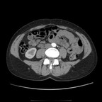 Utérus polyfibromyomateux Artériel Utérus polyfibromyomateux Artériel