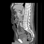 Abcès du psoas à point de départ appendiculaire. TDM abdomen pelvis sagittal veineux Abcès du psoas à point de départ appendiculaire. TDM abdomen pelvis sagittal veineux