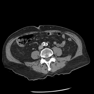 traumatisme ouvert abdominal, saignement actif pariétal abdomen tardif ax
