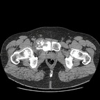 Osteoblastoma BASSIN MOU Osteoblastoma BASSIN MOU