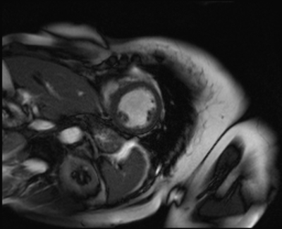 Syndrome de Tako-Tsubo - Myocardite adrénergique Cine-IRM bSSFP petit axe