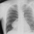 Right pneumothorax AP Chest X-ray Right pneumothorax AP Chest X-ray